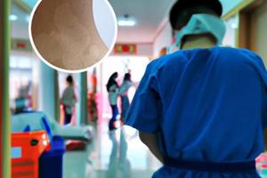 中药熏蒸后皮肤红白相间