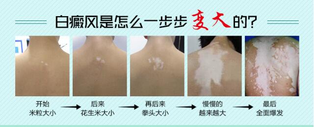 白癜风慢慢变大.jpg 白癜风的初期症状及图片