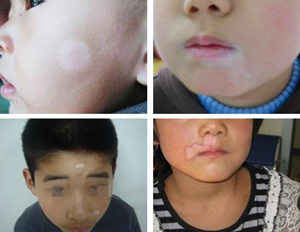 小孩脸上有白斑怎么办?