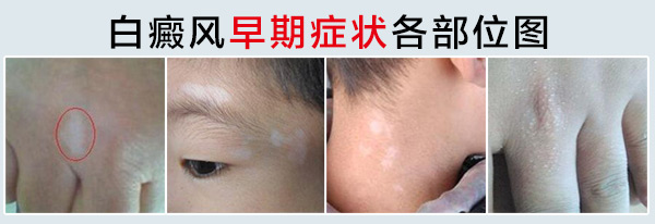 白癜风早期症状各部位图.jpg 白癜风的初期症状及图片