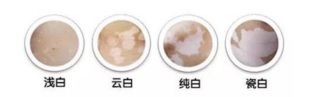 四种颜色.jpg 白癜风的初期症状及图片