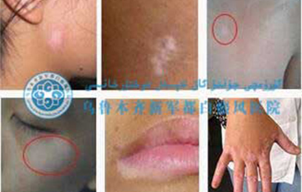 86931513322344.jpg 皮肤出现白斑的原因是什么?