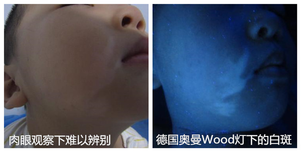 小孩脸上有白斑怎么办?